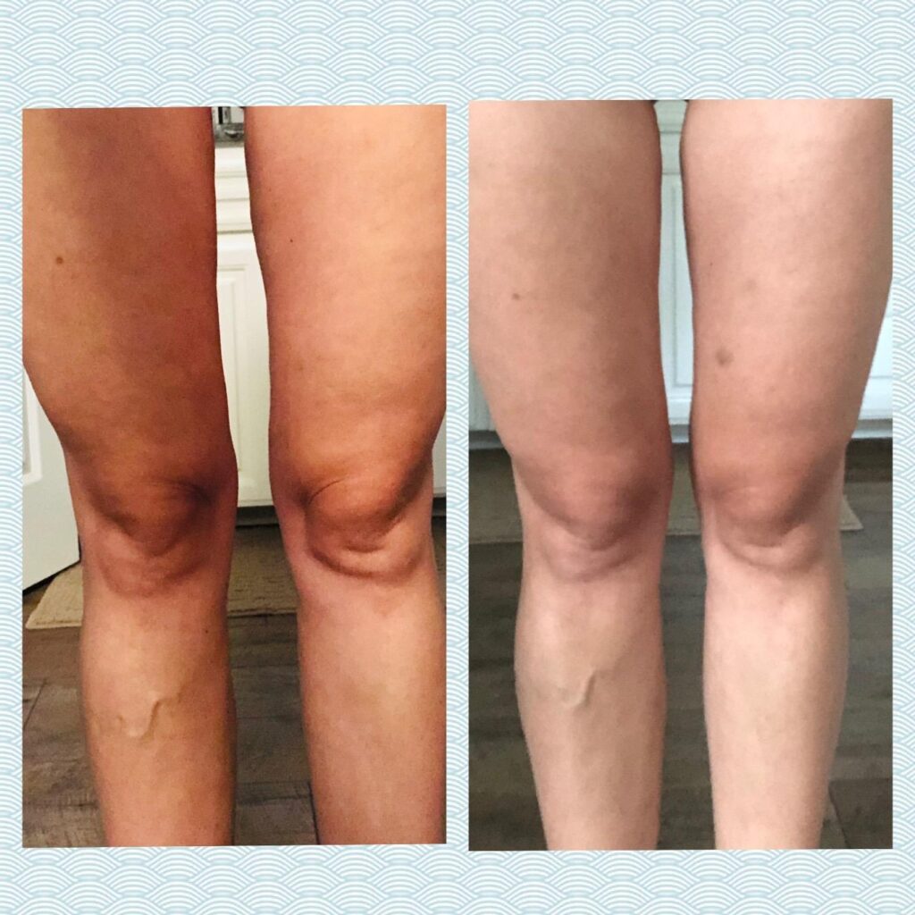 anti cellulite massage oil before and after 