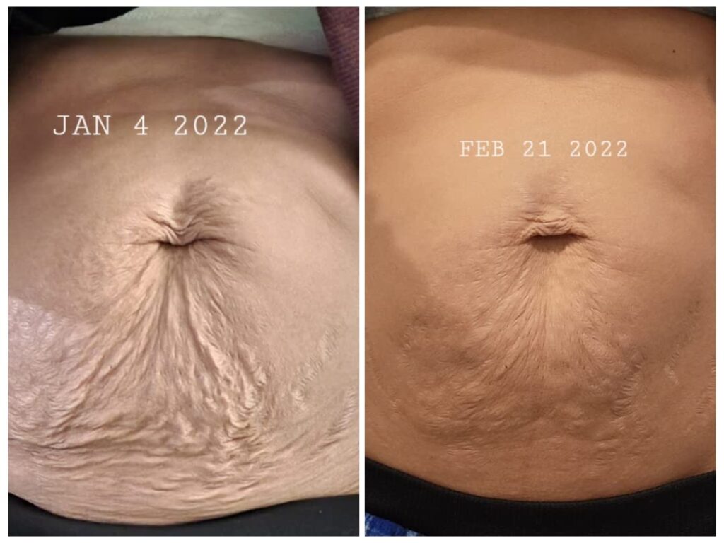 anti cellulite massage oil before and after