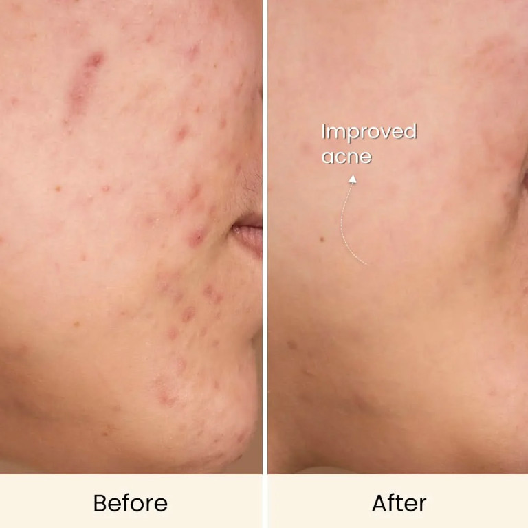 led skin care device